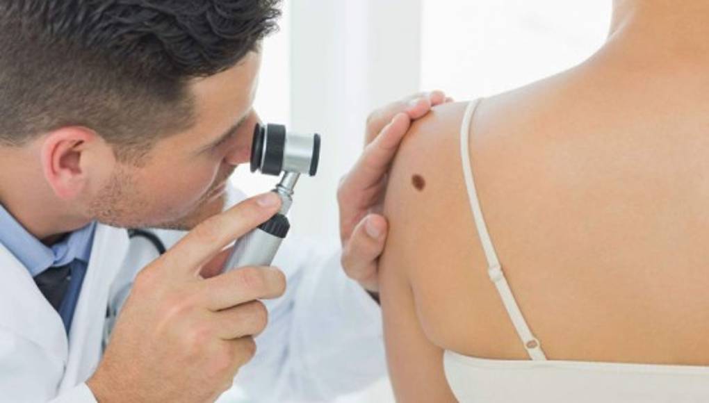 Los melanomas aparecen en personas con menos lunares