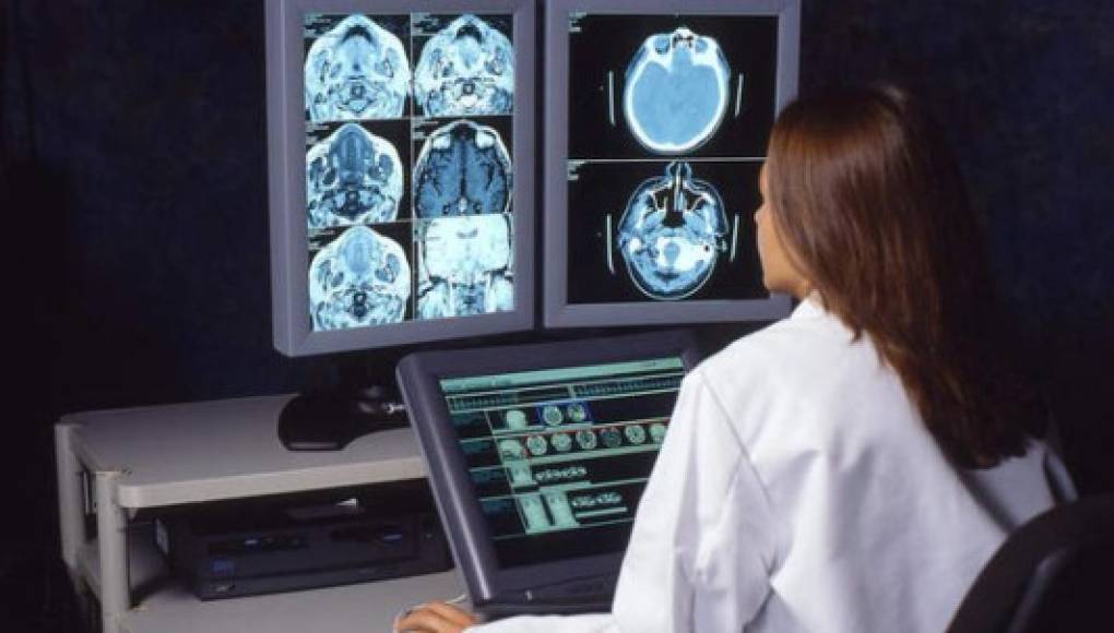 Unos escáneres del cerebro ofrecen pistas sobre el riesgo futuro de ACV