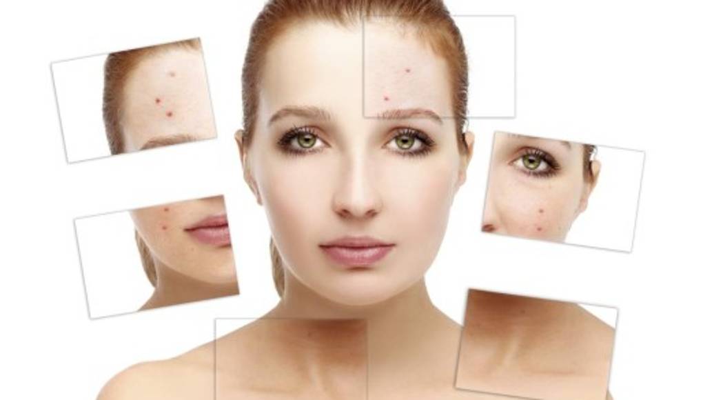 El acné aparece a cualquier edad