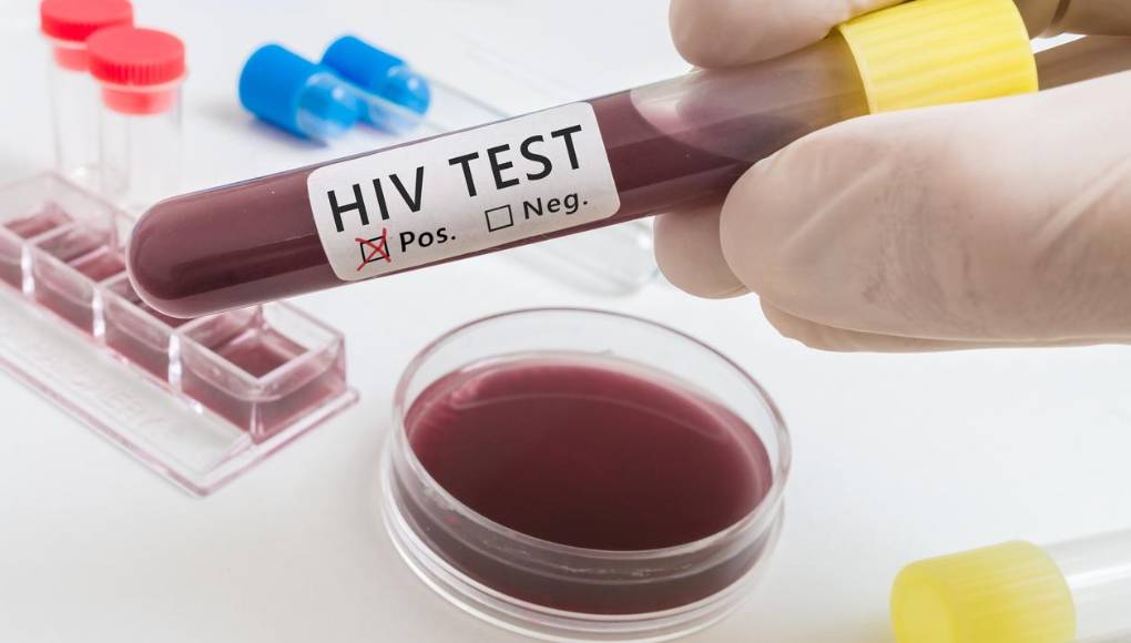 Un nuevo caso de remisión del VIH tras un trasplante de médula ósea