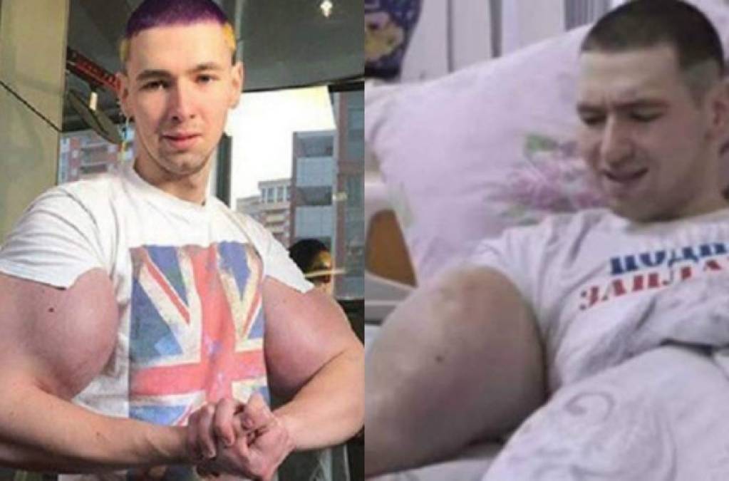 Kirill Tereshin, más conocido como el Popeye ruso, se ha sometido a una cirugía para evitar la muerte ya que no soportaba más el dolor en sus brazos.