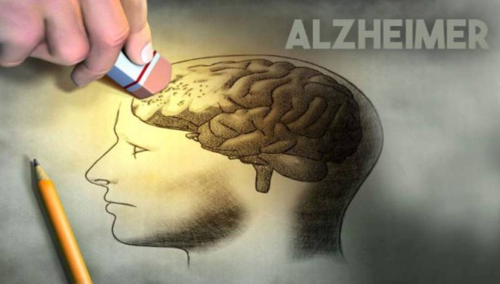 Un 'marcapasos' cerebral podría ayudar a relentizar el Alzheimer
