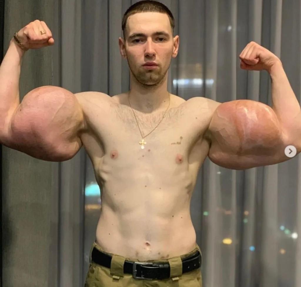 Deportista 'Popeye ruso' hace dramática confesión: podría perder los dos brazos