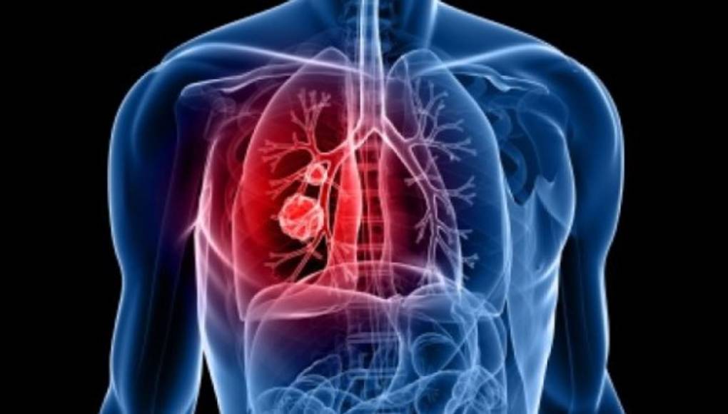 El tabaco es responsable de casi 50% de decesos por 12 tipos de cáncer