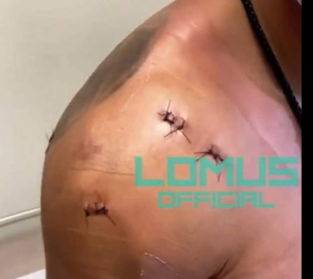 Personas cercanas a Lomachenko han señalado que el ucraniano tenía problemas con su hombro previo al combate ante Teófimo López.