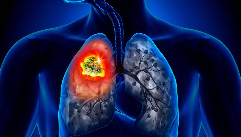 Expertos vinculan el aire sucio al cáncer pulmonar