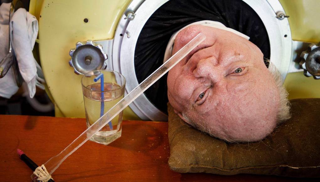 La polio, una enfermedad que afectó gravemente a Alexander y a muchos otros, fue prácticamente erradicada en el mundo occidental gracias a la vacuna desarrollada en la década de 1950. 