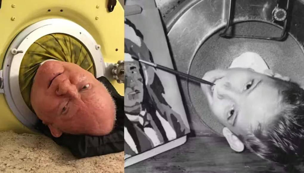 El “viejo caballo de acero”, como Alexander llamaba a su pulmón artificial, se convirtió en un símbolo de su tenacidad y resiliencia. A pesar de las limitaciones físicas, el hombre logró respirar por sí mismo después de años de esfuerzo, permitiéndole salir del pulmón por períodos cortos de tiempo.