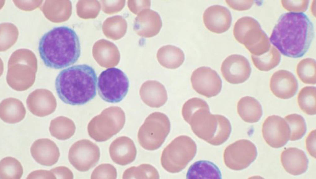 Las células madre del cordón umbilical pueden ayudar a pacientes con leucemia