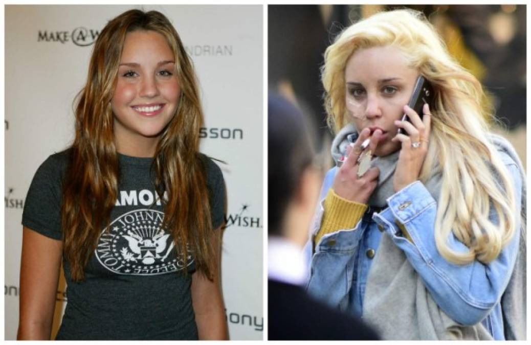 Amanda Bynes hizo un cambio radical en su rostro dede los pómulos hasta los ojos.