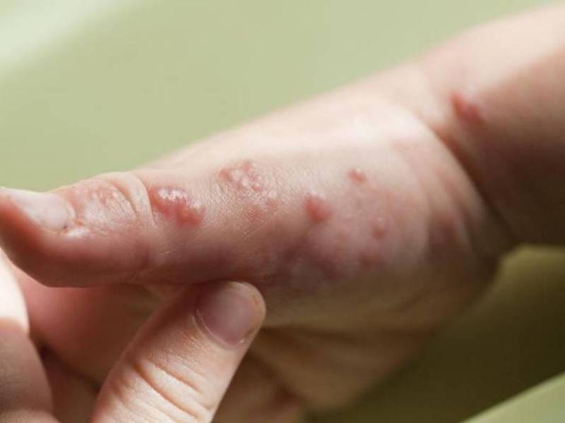 “Ayer, en horas de la tarde, se confirmó el primer caso de viruela del mono en nuestro país” informó el titular de Salud de ese país centroamericano.