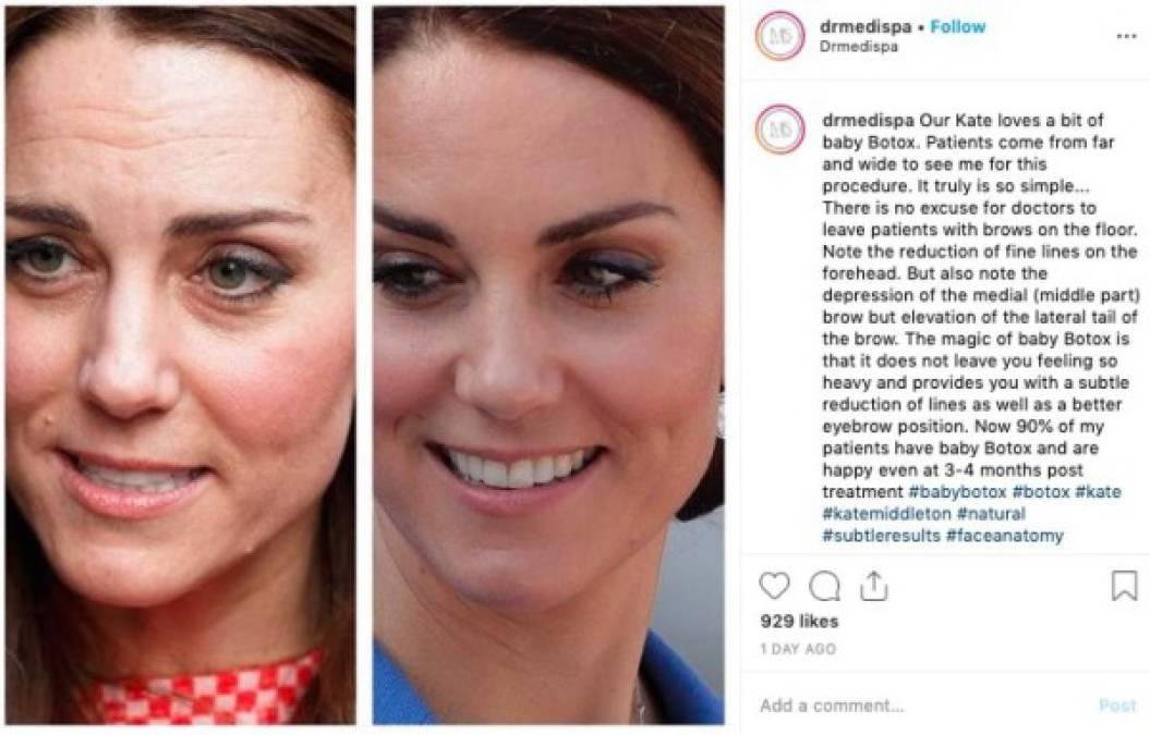 Munir Somji, del Dr. Medi Spa Clinic en Londres, publicó las imágenes en su cuenta de Instagram, que eliminó poco después.<br/><br/>'Nuestra Kate ama un poco de baby Botox', escribió el especialista junto a las presuntas fotos del 'antes', donde se ve cansada y tiene arrugas, y el 'después', donde la madre de tres aparece impecable y radiante.