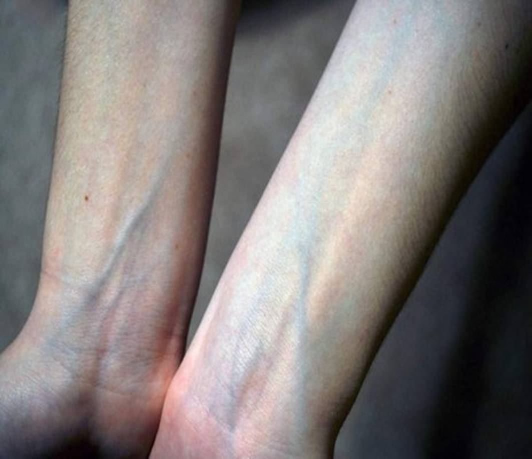 ¿Por qué las venas son azules? Pero si la sangre nunca deja de ser roja, ¿por qué vemos las venas de color azul? Simple y llanamente por una cuestión de luz. La luz penetra por nuestra piel para iluminar las venas. En este continuum de luz ingresa luz tanto roja como azul, aunque ambas con diferentes longitudes de onda.