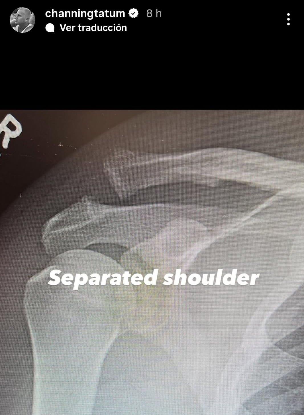 Radiografía del hombro de Channing Tatum antes de ser operado.