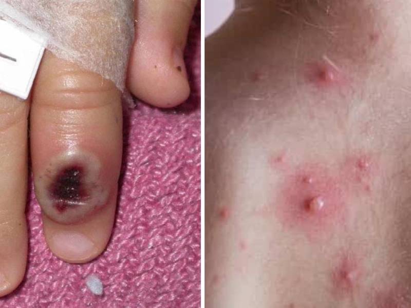 Honduras ha confirmado tres contagios de viruela del mono y hay diez casos sospechosos.