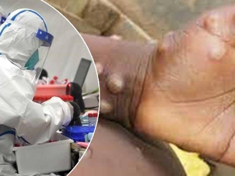 Datos de la OMS muestran que la mayoría de los casos reportados han sido en hombres que han tenido relaciones sexuales con hombres. Foto Agencia Reforma