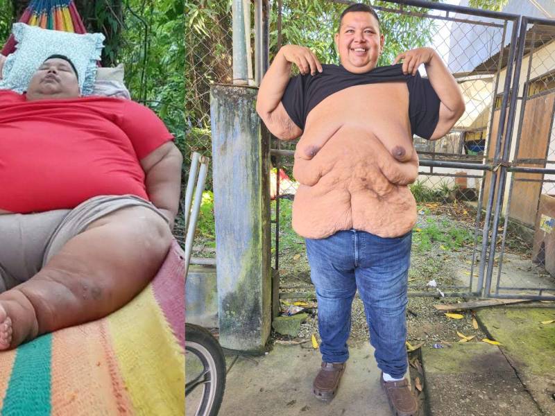 Elder estuvo diez meses en dieta, ejercicio y controles constantes previo a la cirugía bariátrica.