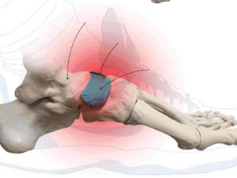 El hueso escafoide del que fue operado Denil Maldonado.