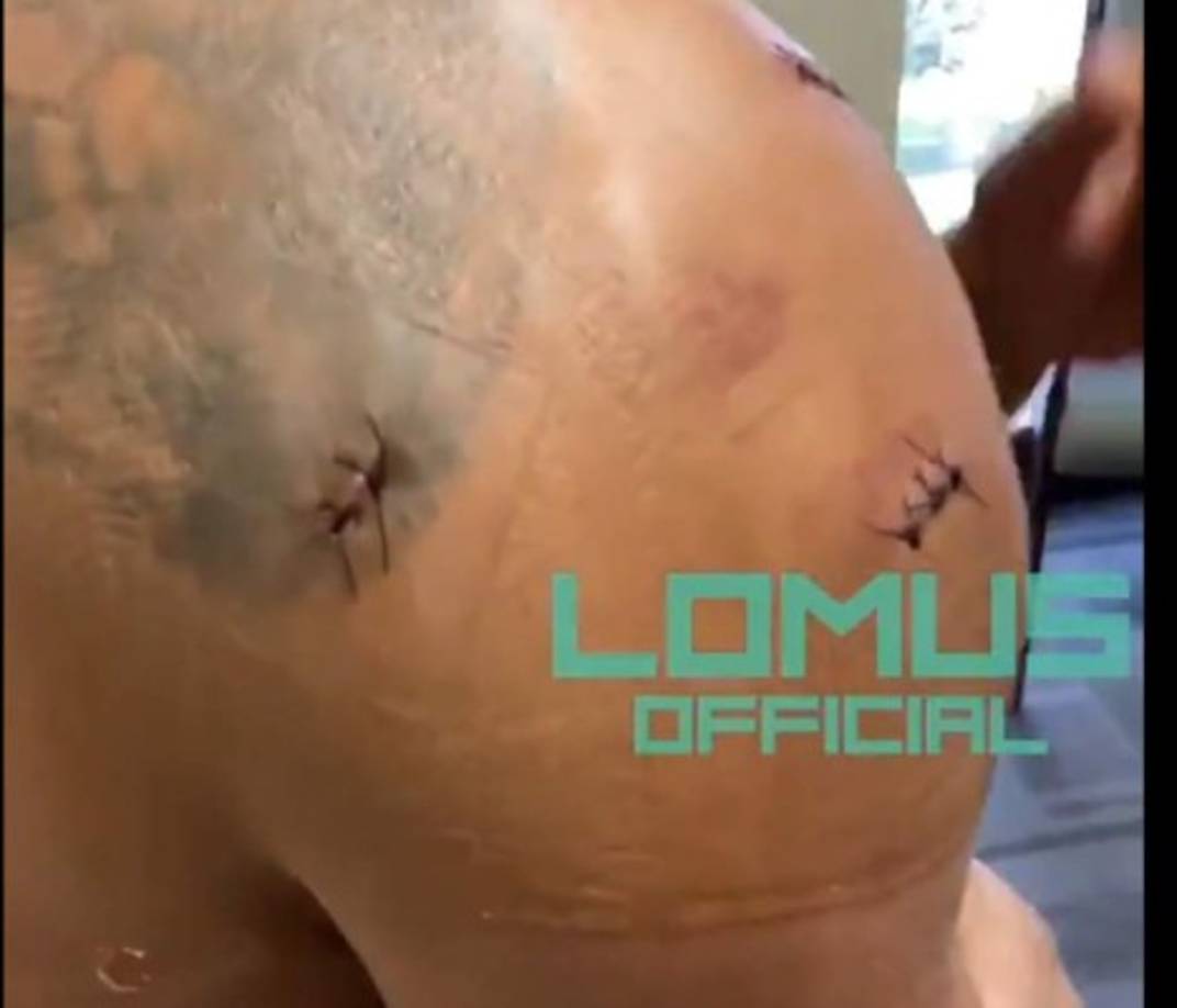 'Se había lastimado severamente el manguito de los rotadores y se rompío un pedazo de cartílago. Esto fue apenas seis semanas antes de la pelea', dijo el mánager de Lomachenko.