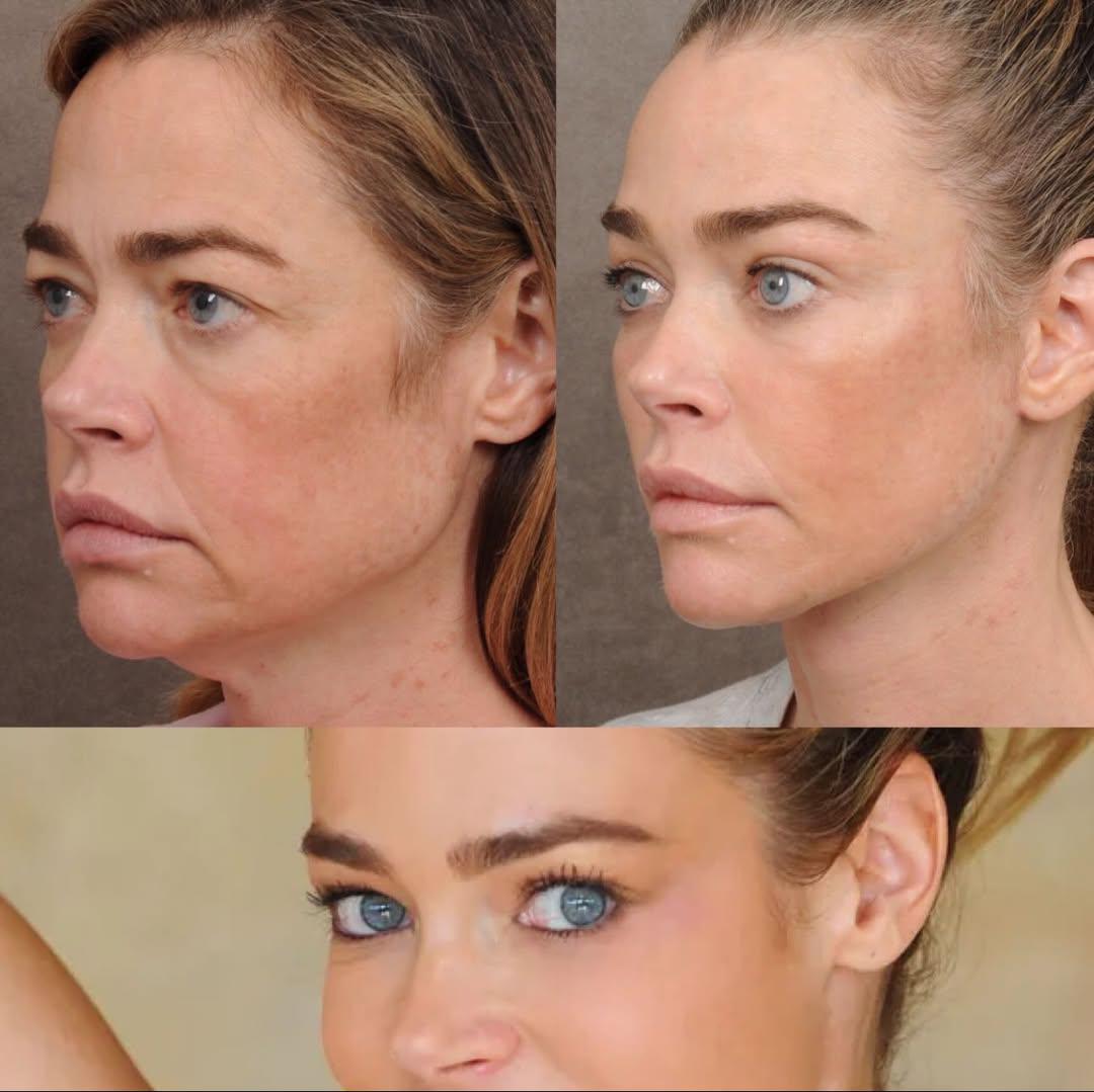 Denise Richards revela detalles de su lifting facial a los 54 años