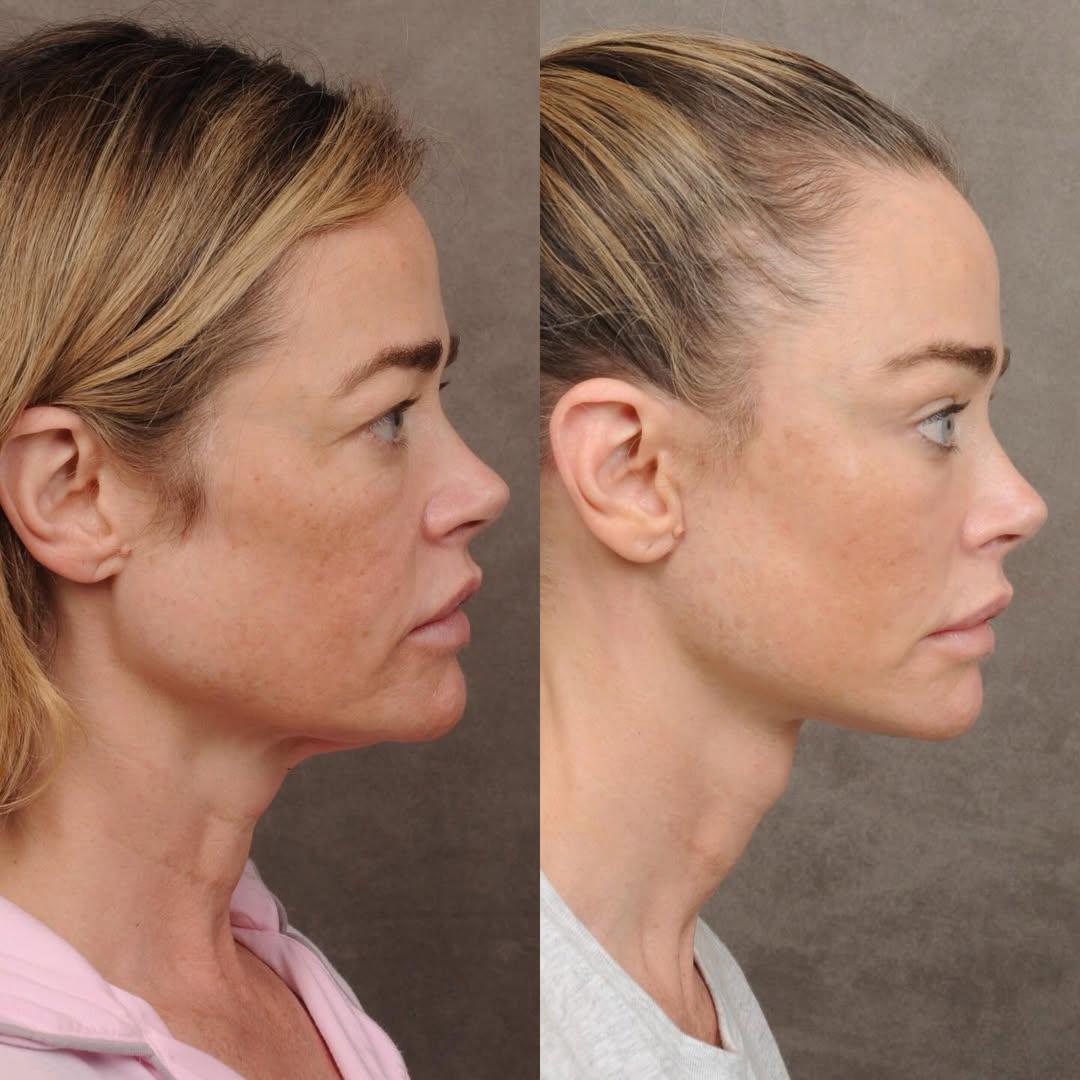 Denise Richards revela detalles de su lifting facial a los 54 años