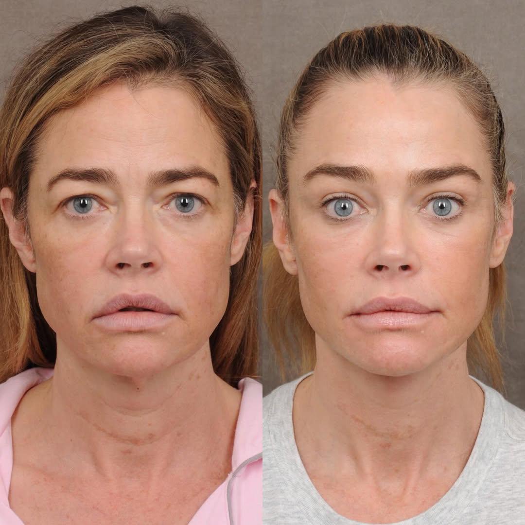 Denise Richards revela detalles de su lifting facial a los 54 años