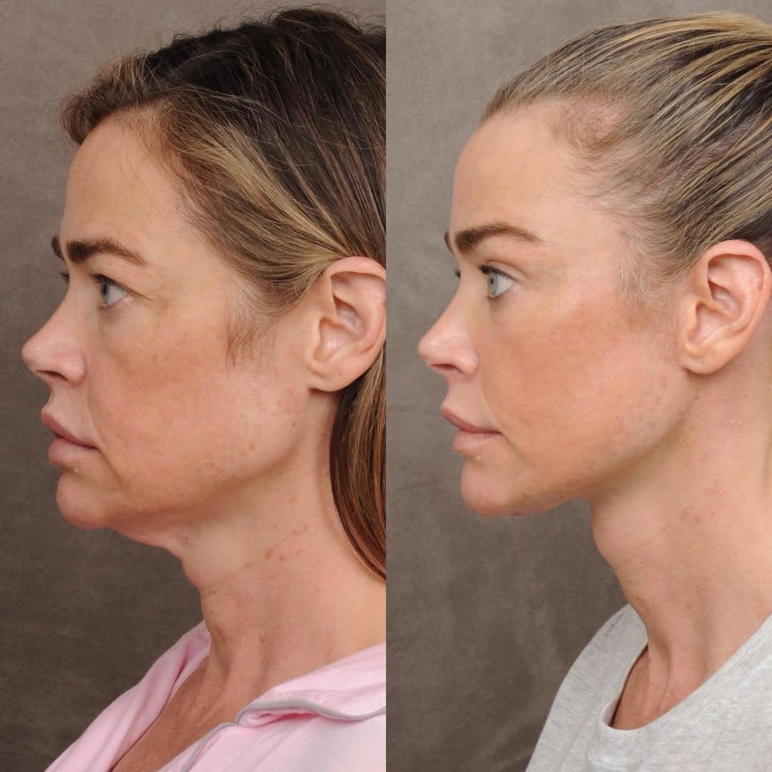 Denise Richards revela detalles de su lifting facial a los 54 años
