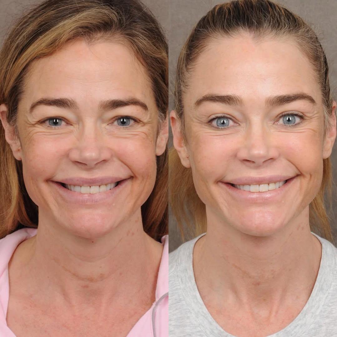 Denise Richards revela detalles de su lifting facial a los 54 años