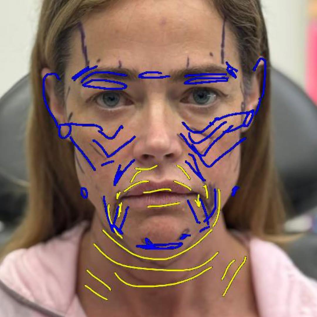 Denise Richards revela detalles de su lifting facial a los 54 años