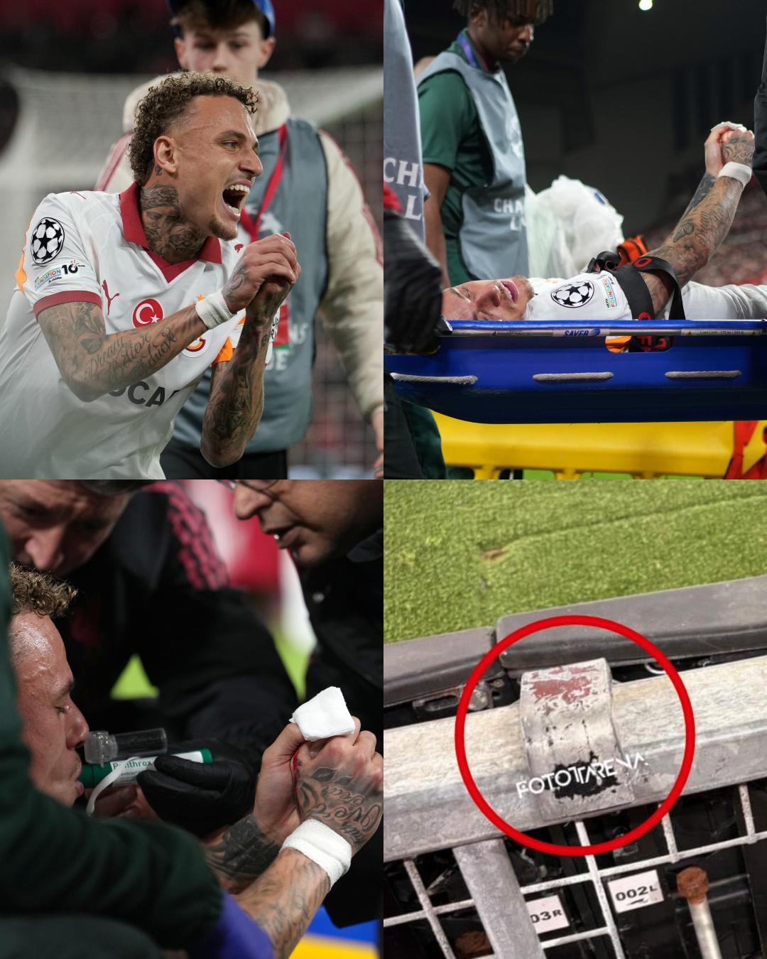 Impacto en Champions: sufre amputación parcial por lo que le pasó en partido