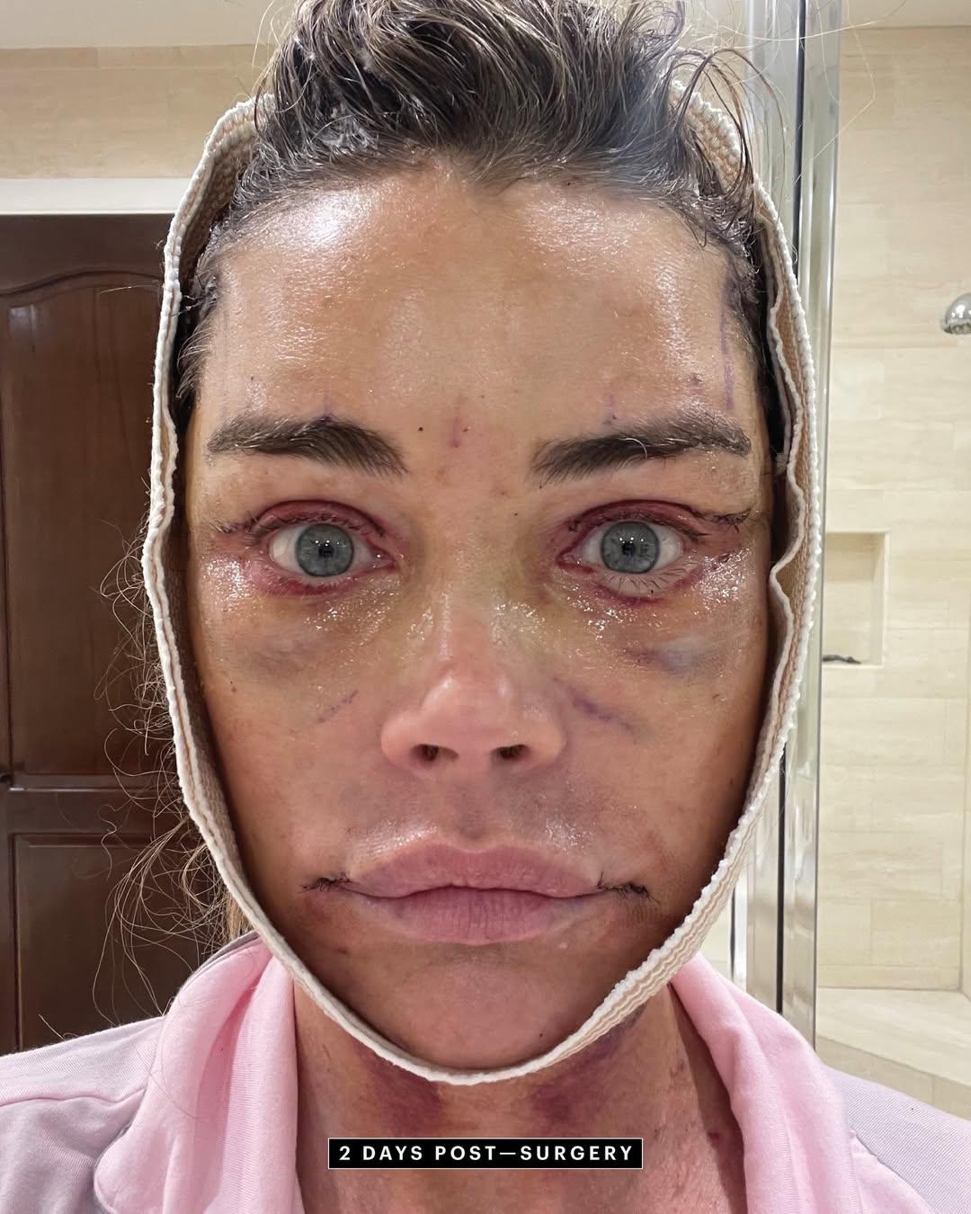 Denise Richards revela detalles de su lifting facial a los 54 años