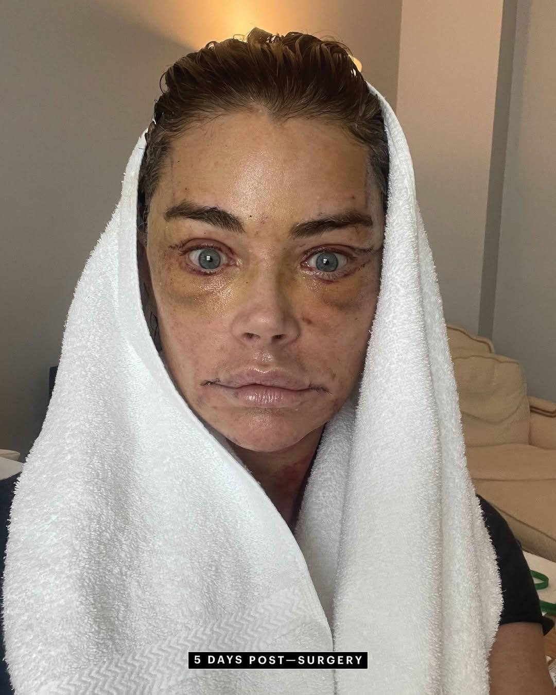 Denise Richards revela detalles de su lifting facial a los 54 años