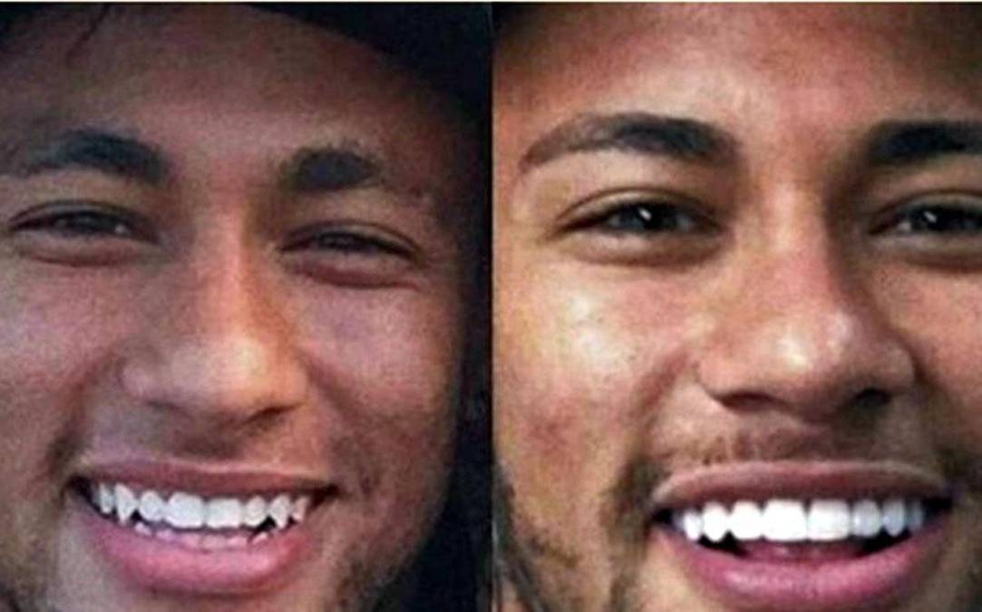 Neymar - El crack brasileño aprovechó en unas de sus vacaciones en Brasil, cuando era jugador del Barcelona, para realizar un viaje relámpago hasta Sao Paulo y pasar por el dentista, que se encargó de ponerle una nuevas fundas a sus dientes.