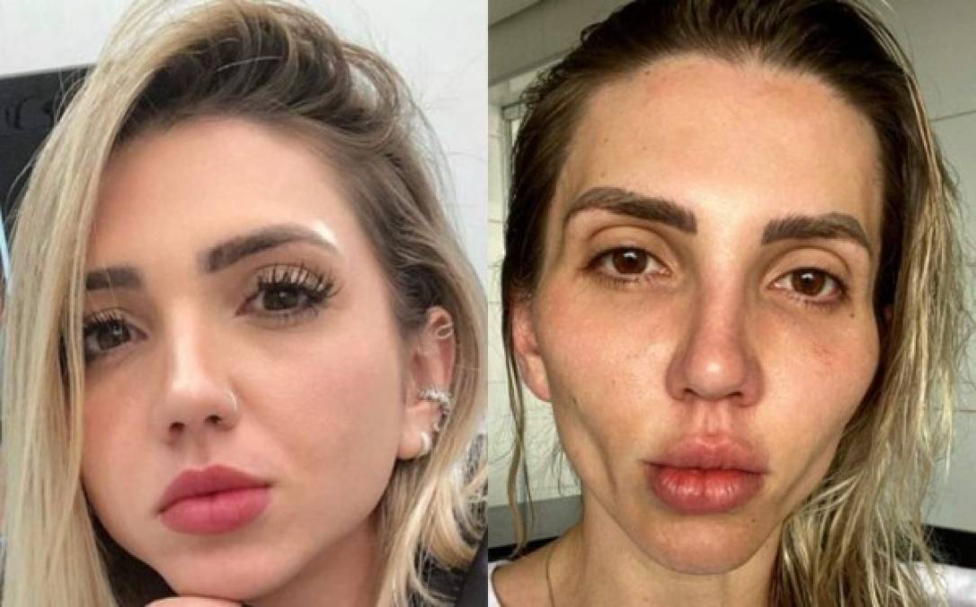 Jéssica Frozza es una influencer y tiktoker brasileña que, hace dos años, se sometió a una cirugía estética llamada “bichectomía”, pero con el tiempo los resultados no fueron los esperados. Fotos @euroufrozza / Instagram