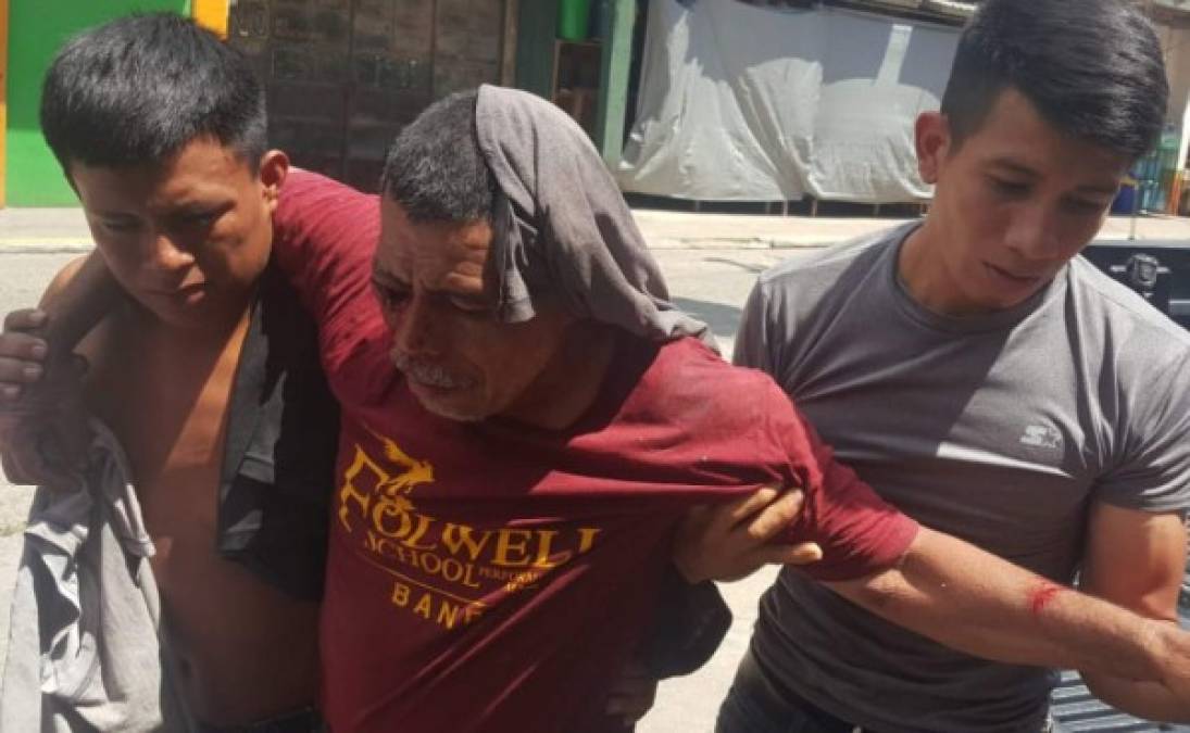 Este hombre resultó con heridas luego de las protestas en Trujillo donde la Policía tuvo que intervenir para disuadir a los manifestantes.