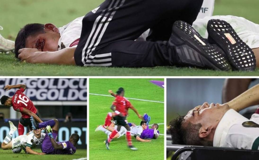 Hirving 'Chucky' Lozano, delantero de la Selección de México, sufrió un terrible golpe en el rostro tras un duro choque con el portero de Trinidad y Tobago en el inicio de la Copa Oro 2021 en Estados Unidos.