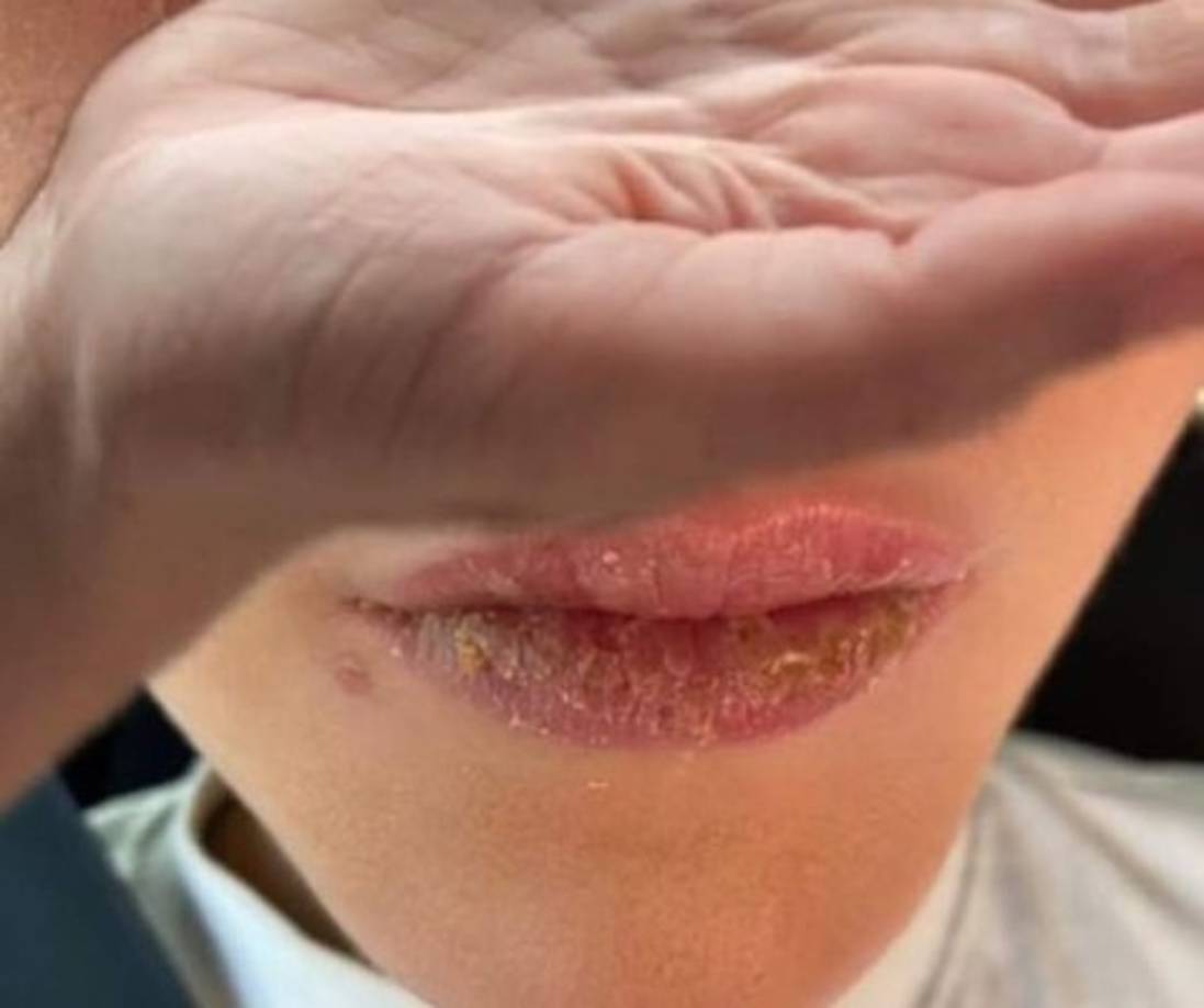 Esta medicina tiene como efecto secundario resecar los labios de quien la consumen, pero aunado con los efectos secundarios de la mutación dieron como resultado a este hongo. <br/><br/>Una vez que acudió al médico le dijeron que tenía una rara infección llamada mucormicosis.