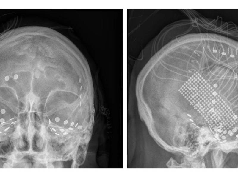 Electrodos registraron señales del cerebro de pacientes con epilepsia mientras escuchaban “Another Brick in the Wall”.