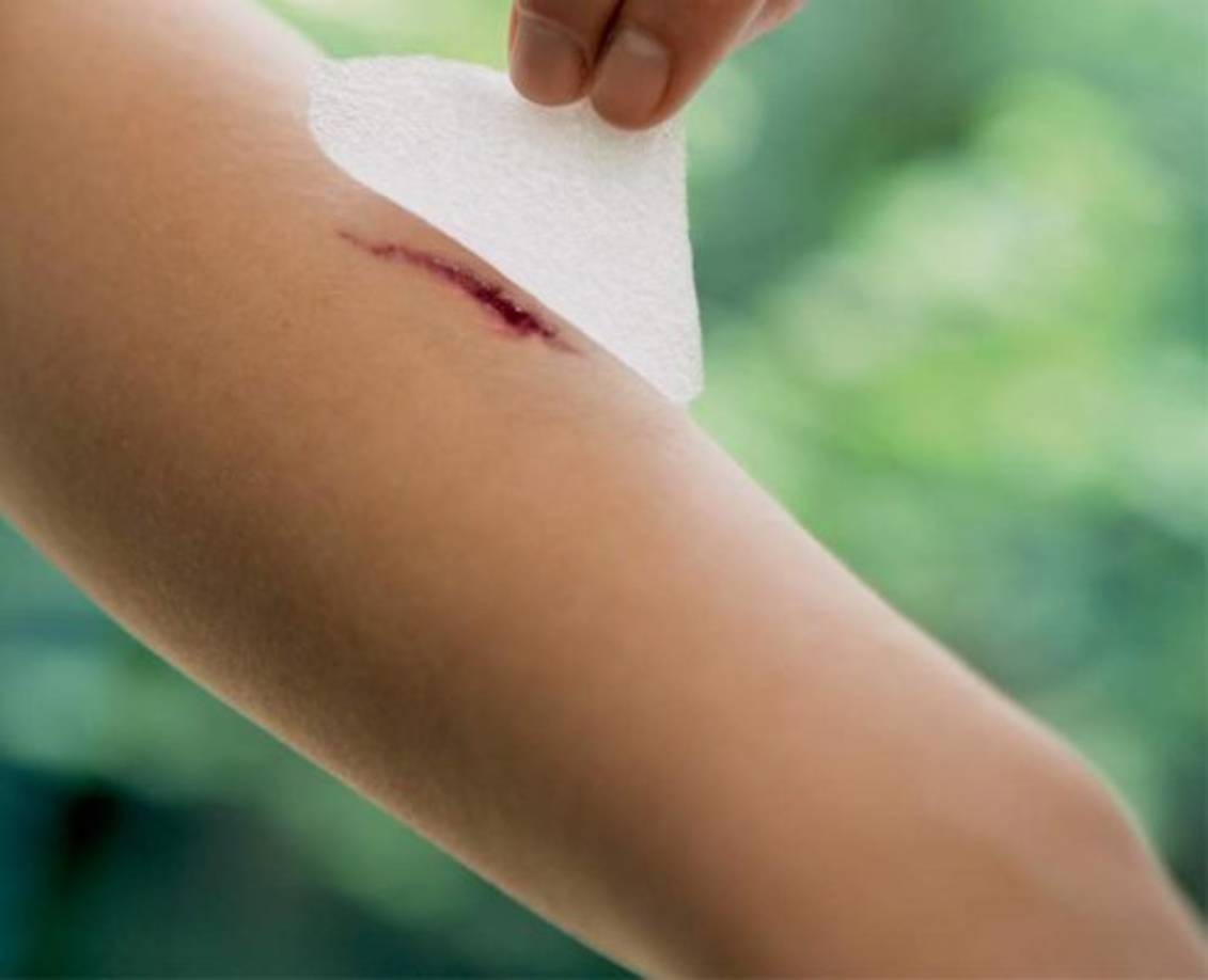 Heridas que no cicatrizan.