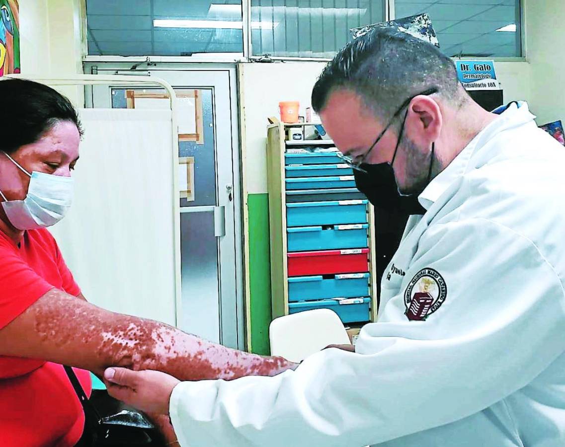 De 5 a 10 nuevos pacientes con vitiligo llegan al mes al Rivas por tratamiento