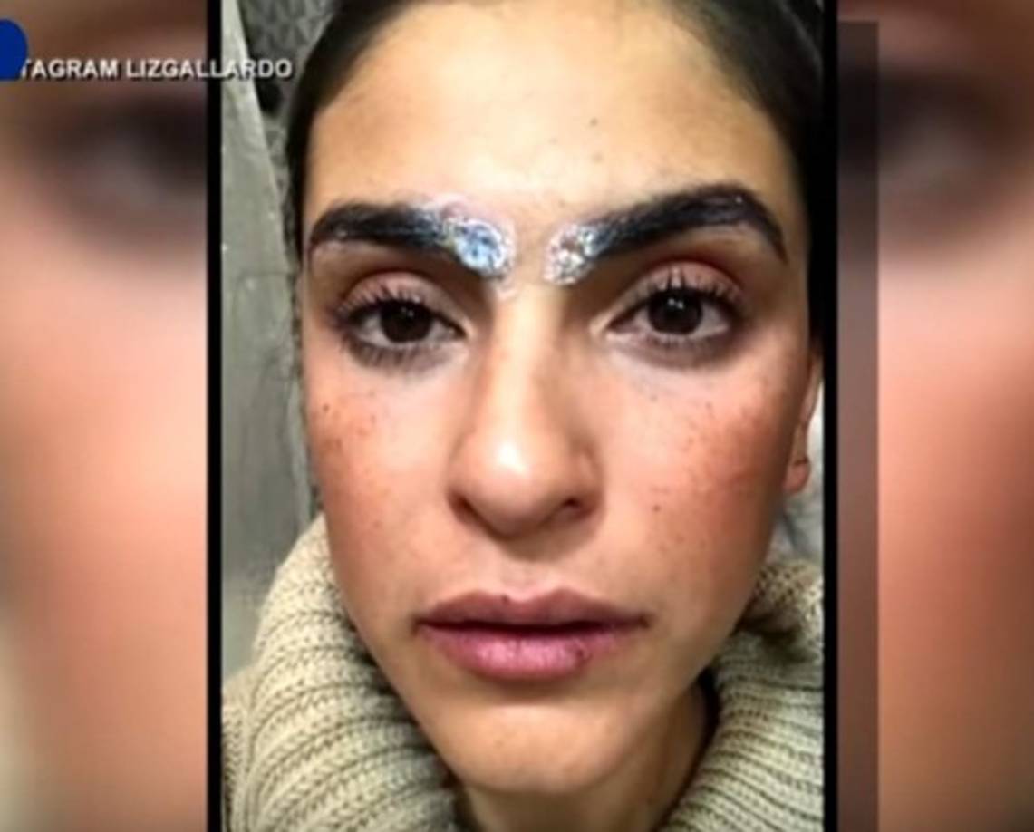 La intérprete recordó que poco después de que le inyectaran el ácido su rostro empezó a hincharse, y después resultó con quemaduras de segundo grado.