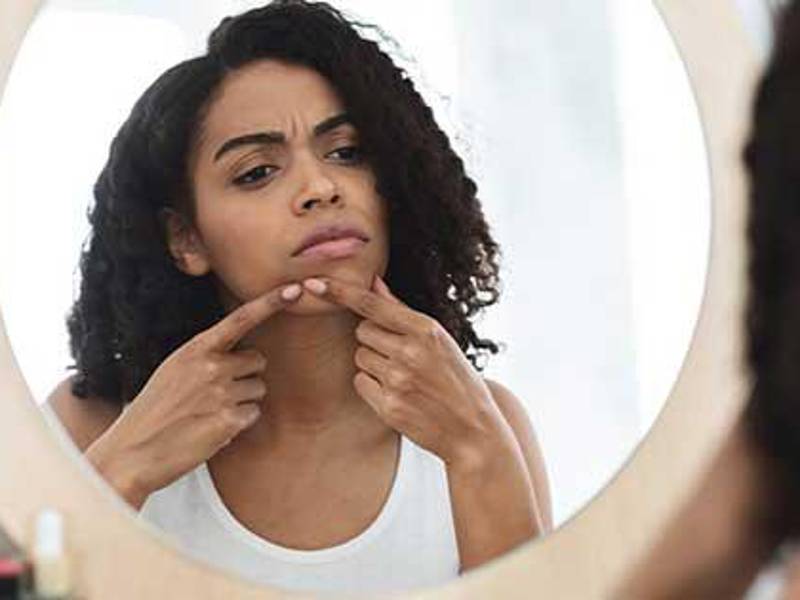 Sépalo. La hiperpigmentación en la piel oscura es más común después de que los brotes han desaparecido