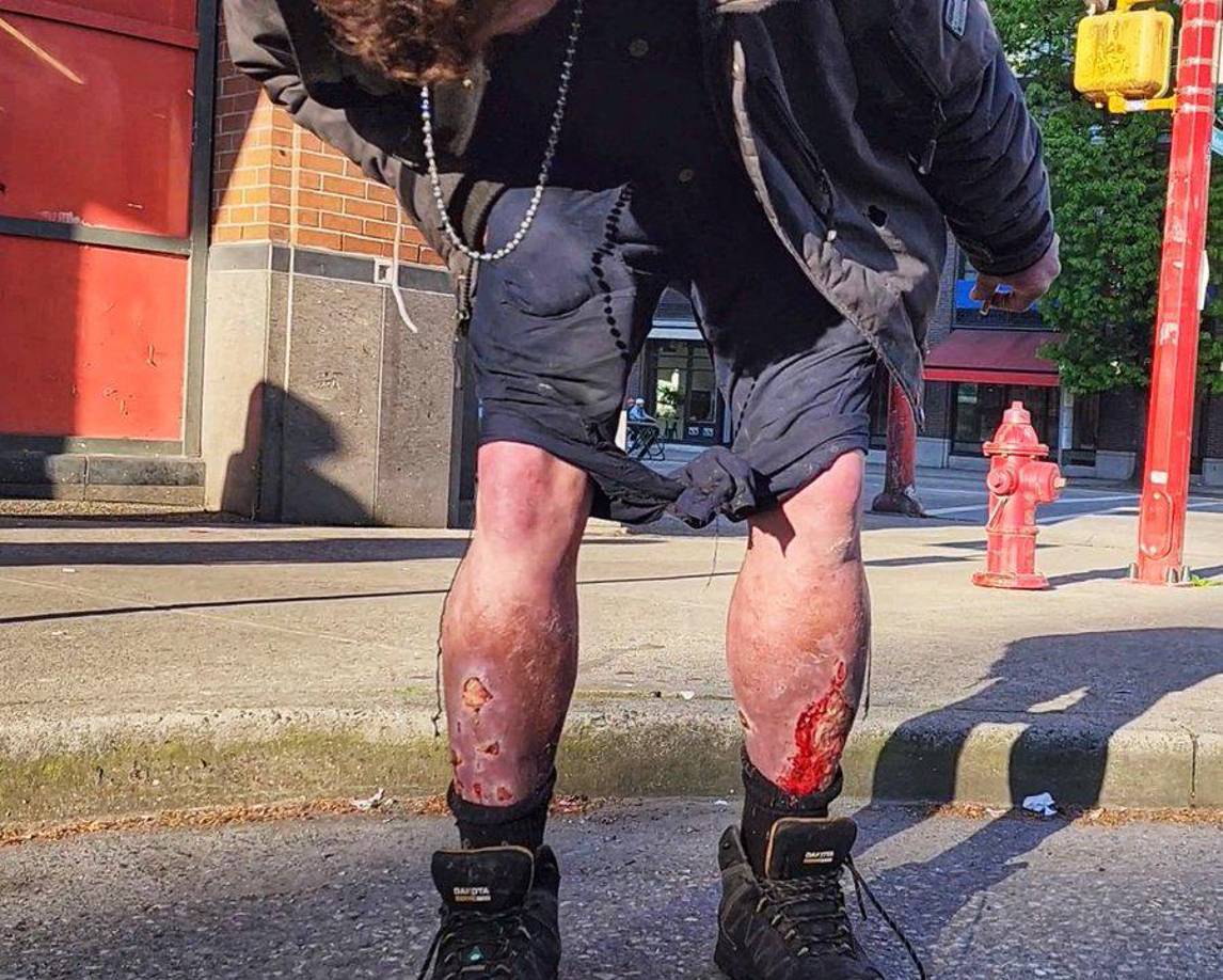 Esta droga, también conocida como tranq, puede causar heridas graves, incluso<b> </b>necrosis, pudriendo la piel lo que puede llevar a amputaciones, según las autoridades sanitarias estadounidenses.