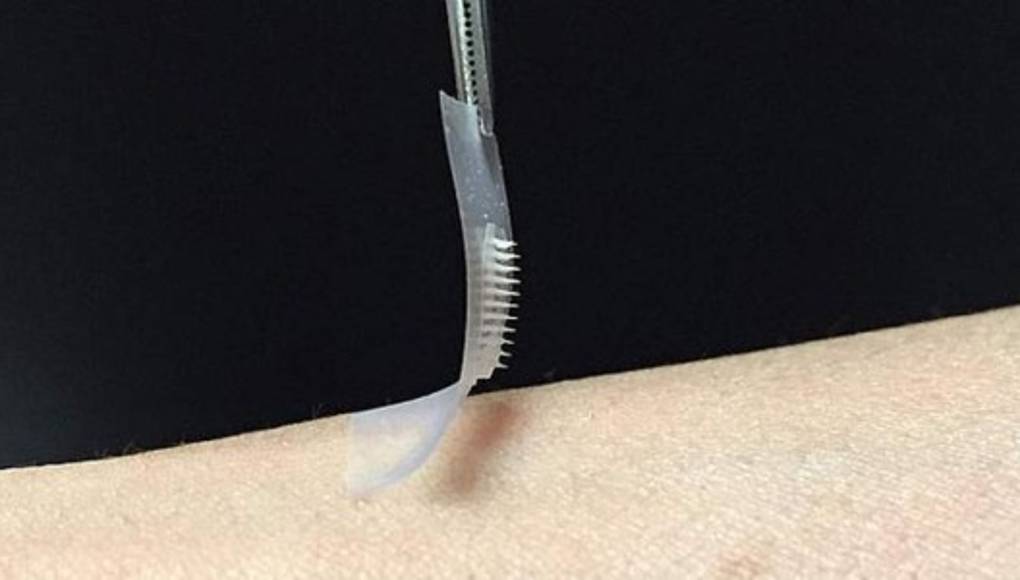 Diseñan parche de insulina para diabéticos que podría sustituir a inyecciones