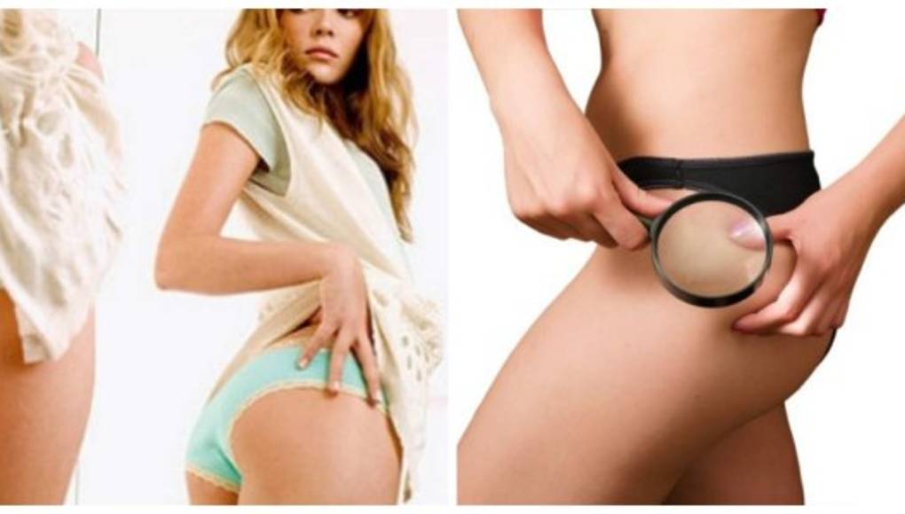 Como combatir la celulitis de forma natural