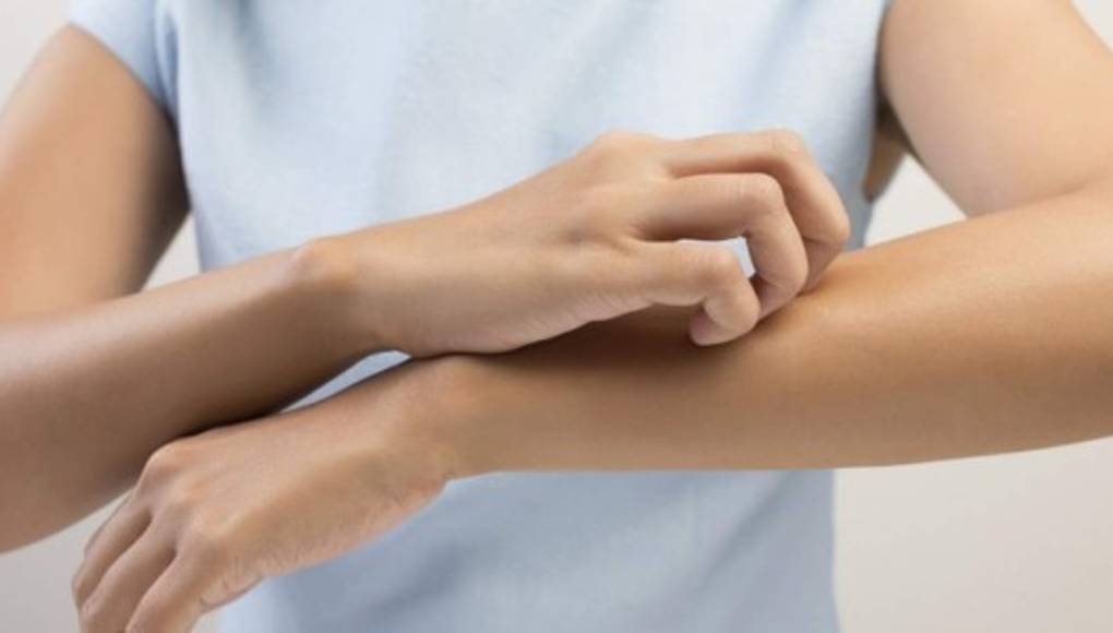 No permita que las chinches afecte su salud