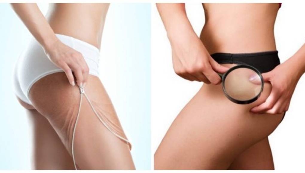 Elimina las estrías con azúcar