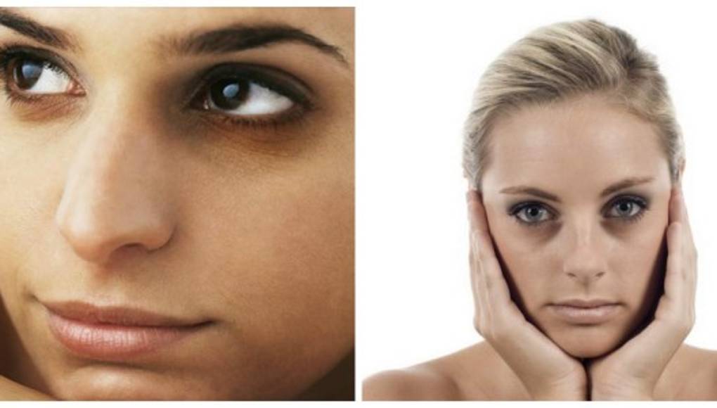 Leche para las ojeras