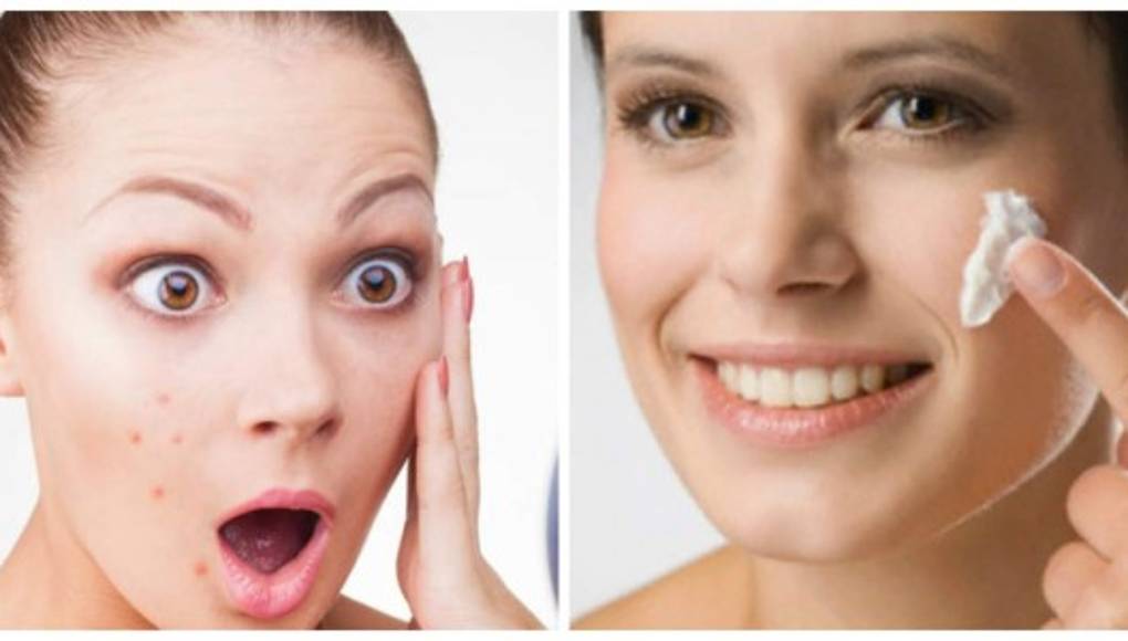 Tips para desaparecer los granos