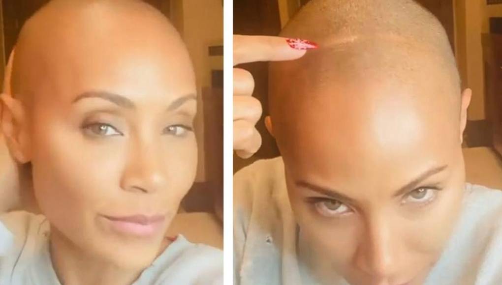 La alopecia o pérdida de pelo en ciertas áreas del cuero cabelludo que sufre Jada Pinkett, la esposa del actor Will Smith, podría estar originada por una predisposición genética que ocasiona una reacción autoinmune y cuyo desencadenante puede estar, entre otros, en alteraciones emocionales.